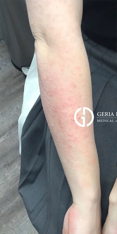 1759525326_92888-1of4 Hair Loss Treatment In New Jersey | Geria Dermatology