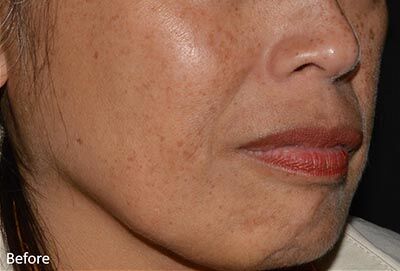 1759526471_0017-1of4 LaseMD Ultra In New Jersey | Geria Dermatology