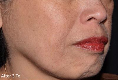 1759526477_0017-2of4 LaseMD Ultra In New Jersey | Geria Dermatology