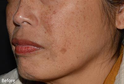 1759528726_0017-3of4 LaseMD Ultra In New Jersey | Geria Dermatology