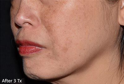 1759528736_0017-4of4 LaseMD Ultra In New Jersey | Geria Dermatology