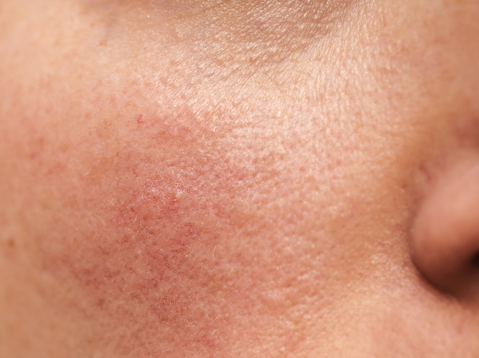 Rosacea In New Jersey | Geria Dermatology